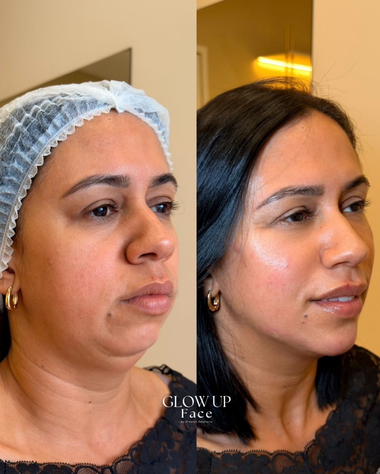 Antes e depois de harmonização facial — Dra. Dinoráh Delatorre