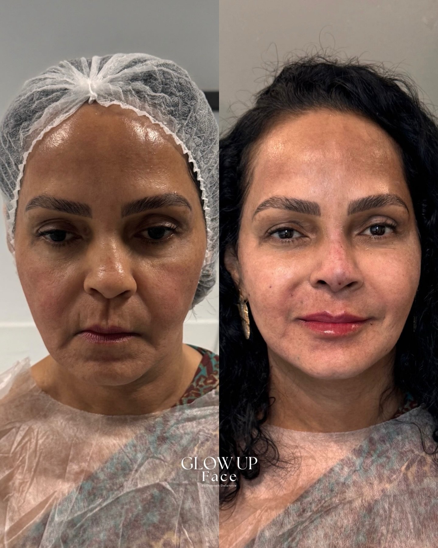 Antes e depois de harmonização facial — Dra. Dinoráh Delatorre