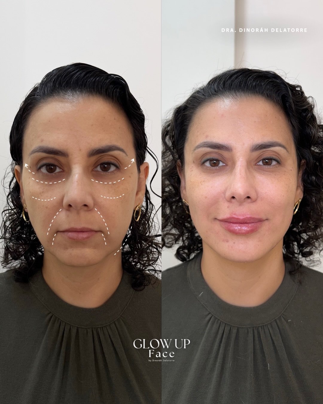 Antes e depois de harmonização facial — Dra. Dinoráh Delatorre