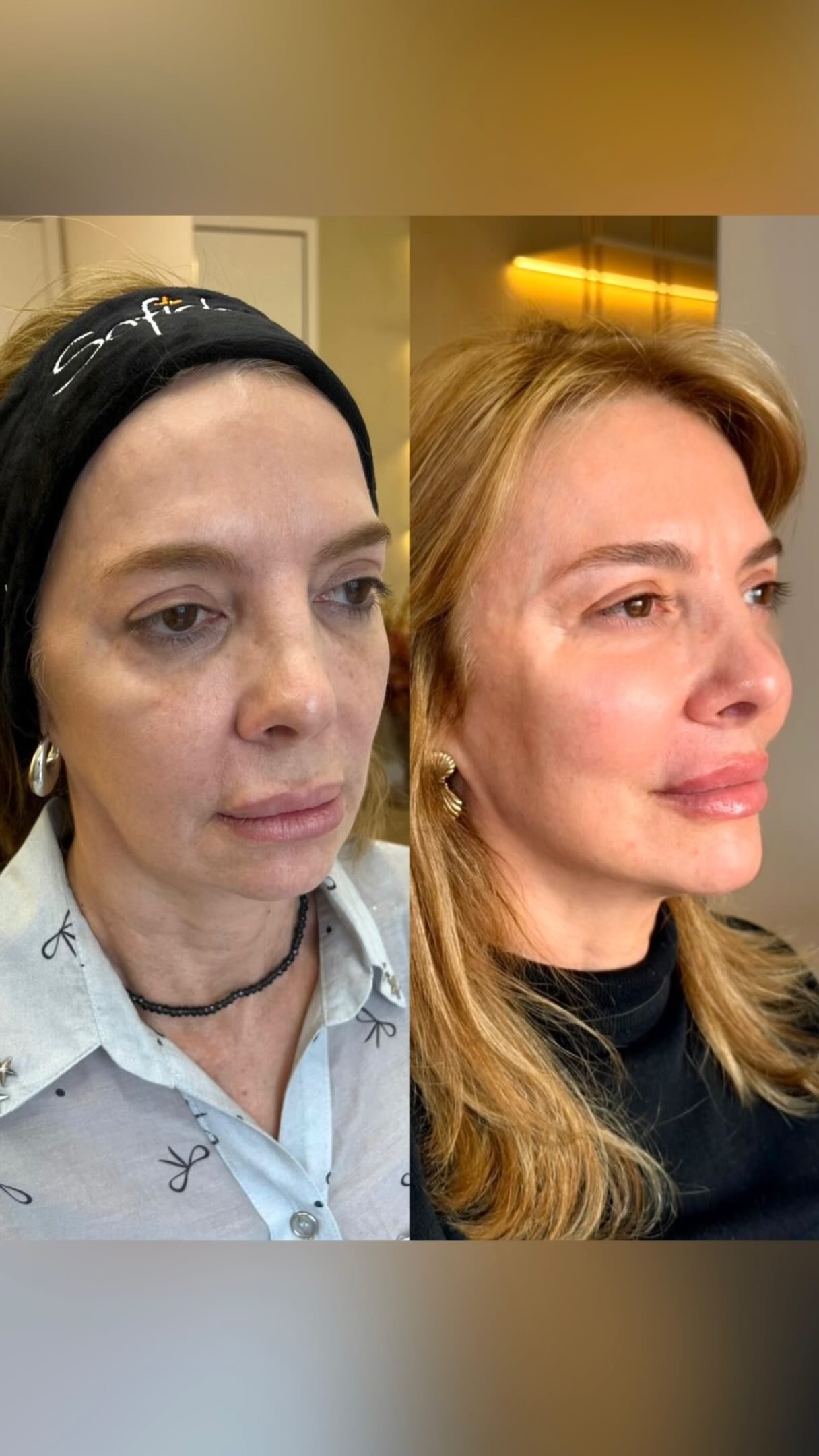 Antes e depois de harmonização facial — Dra. Dinoráh Delatorre