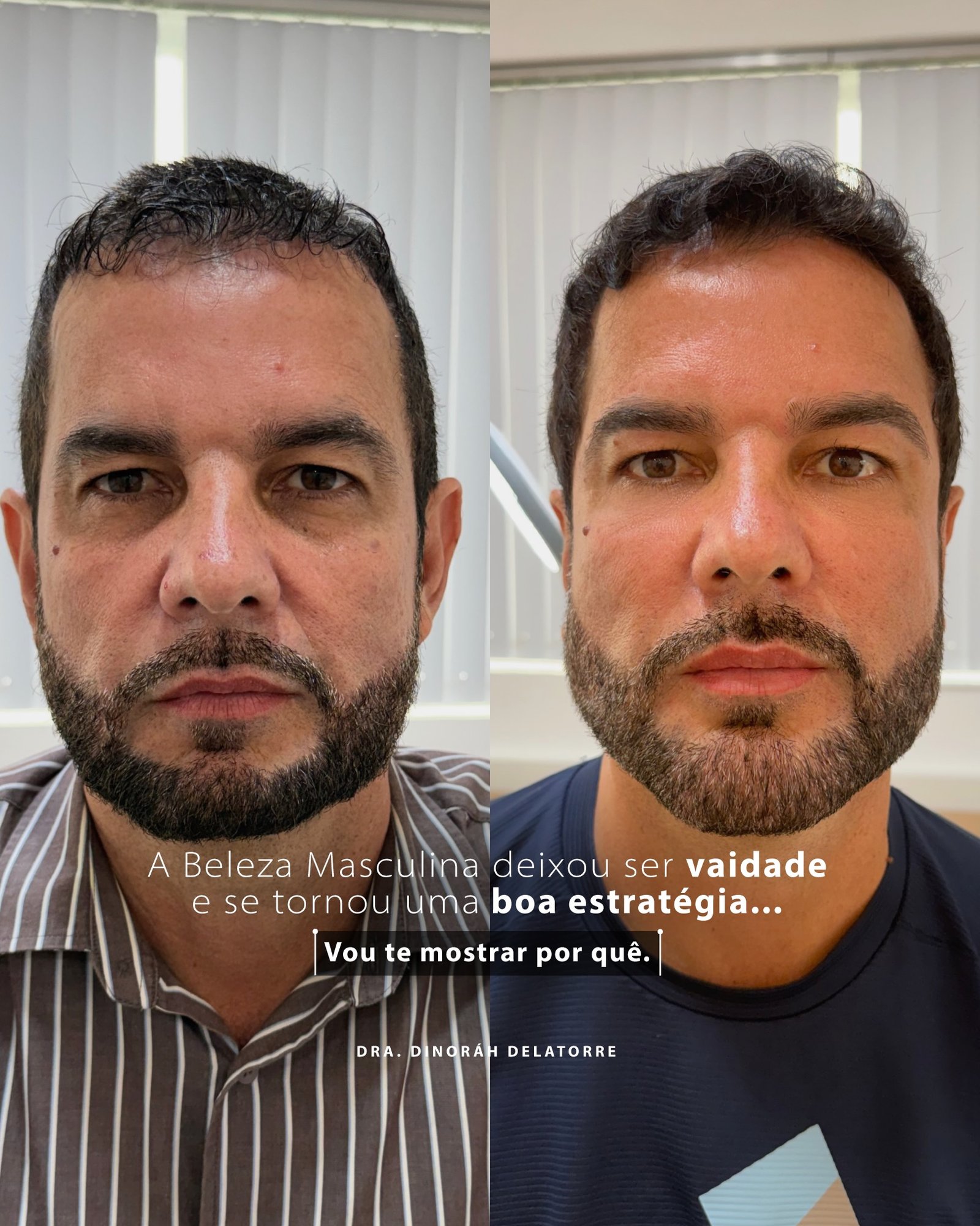 Antes e depois de harmonização facial — Dra. Dinoráh Delatorre