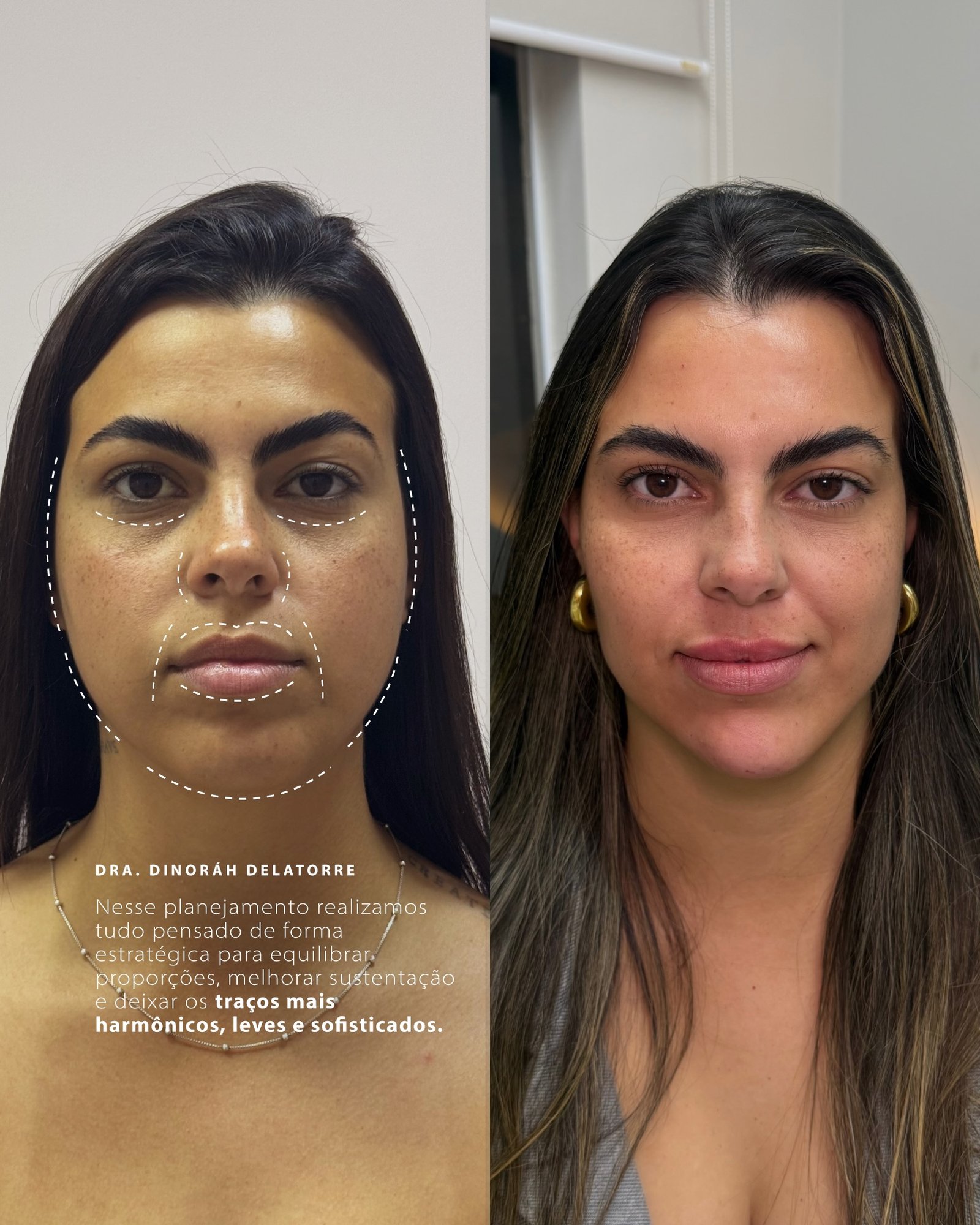 Antes e depois de harmonização facial — Dra. Dinoráh Delatorre